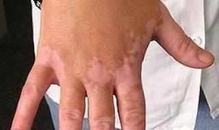 儿童白癜风早期症状是什么怎么判断 白癜风初期症状图片